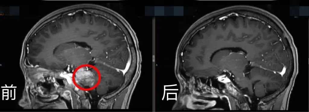 脑部CT前后对比。四川省肿瘤医院供图