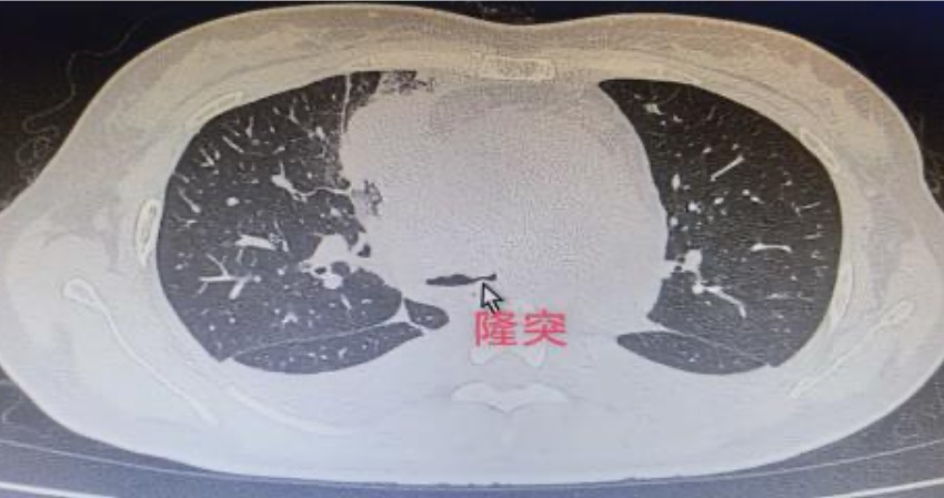 隆突部位。四川省第四人民医院供图