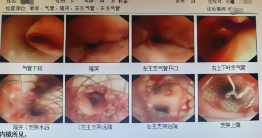 支气管报告单。四川省第四人民医院供图