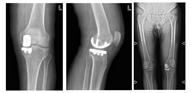 术后X-ray片。绵阳市骨科医院供图
